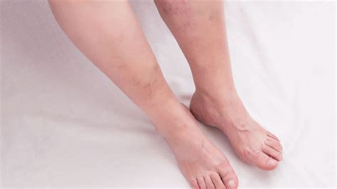 Poor Circulation Leg Sores 的图像结果