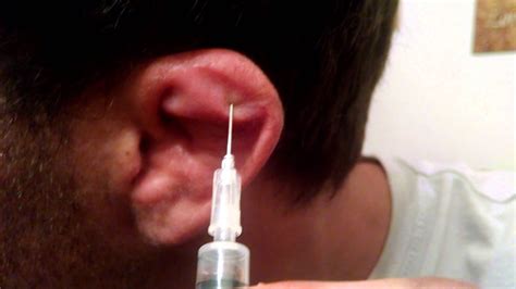 Kuvatulokset haulle cauliflower ear