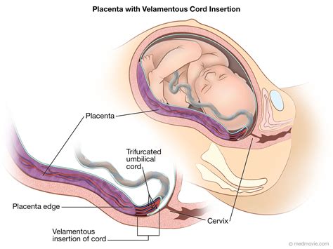 Velamentous Cord Insertion velamentous insertion of umbilical cord ...