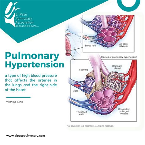 #pulmonaryhypertension #becausewecare #hipertensionpulmonar | El Paso ...