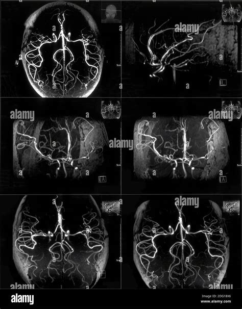 Head Mri With Contrast