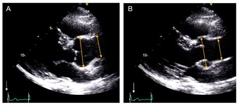 Aortic Root Measurement