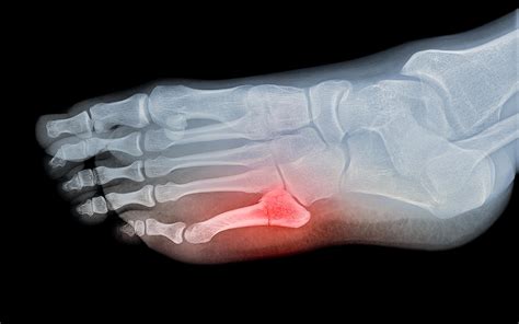 Metatarsal Fractures and Stress Fractures | Great Neck Family Foot Care