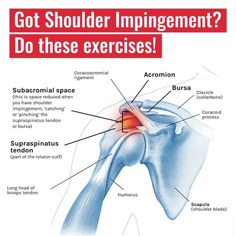 Shoulder impingement syndrome treatment with 4 exercises – Artofit