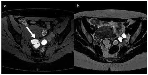 Magnetic Resonance Imaging of Endometriosis: The Role of Advanced ...