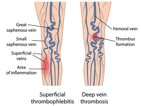 Varicose Veins And Blood Clots