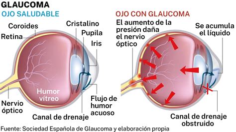 Autodiagnóstico casero para detectar el glaucoma a tiempo