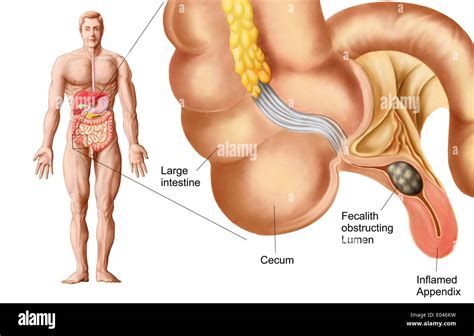 Image result for Normal Appendix Anatomy