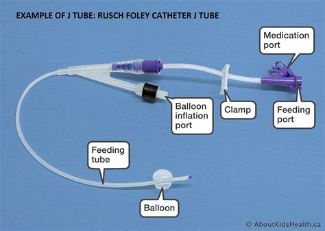 What Is The Process Of Getting A Feeding Tube at Callum Hale blog
