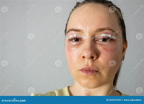 Woman Face after Plastic Surgery, Blepharoplasty Operation, Swelling Eye Bags, Incisions with ...