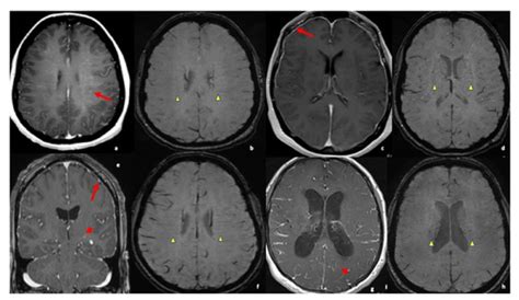 Relevance of Medullary Vein Sign in Neurosarcoidosis