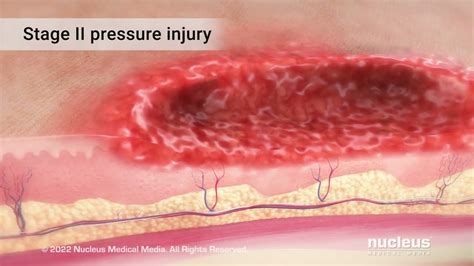 Image result for Deep Tissue Injuries