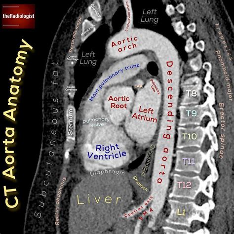 Check out this sagittal view of a CT aorta...⁣ ⁣ TAKE NOTE OF:⁣ ⁣ 📝We can see one branch of the ...
