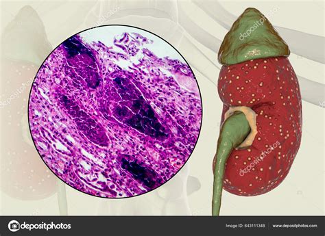 Acute Pyelonephritis Illustration Showing Gross Morphology Focal Small ...