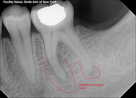 Emergency Root Canal NYC Dentist Tells You Everything You Need To Know