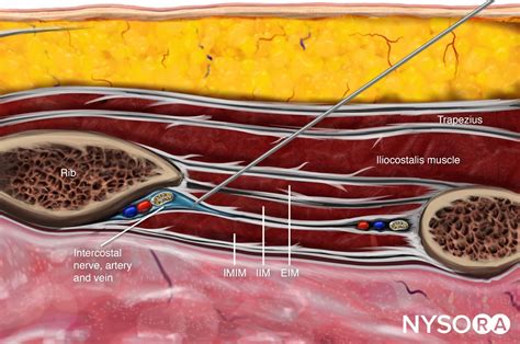 Ultrasound Pain Block Tip of the Week: Intercostal Nerve Block - NYSORA