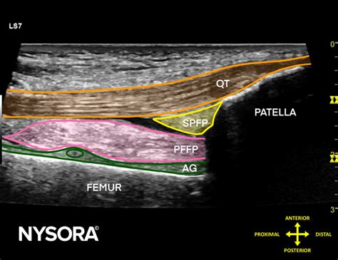 Quadriceps Tendon Lengthening at Eula Seay blog