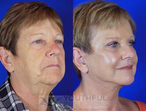 CO2 Laser Skin Resurfacing Before & After Photos Patient 2 | Nashville, TN | Youthful Reflections