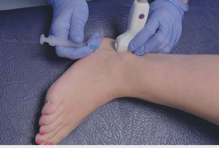 Image result for Ankle Injection Lateral Approach