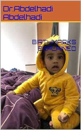 BIRTHMARKS EXPLAINED (HADI BABY PARENTS SERIES Book 3) eBook ...