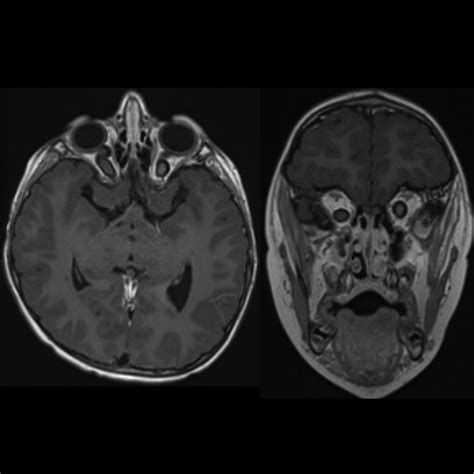 Pediatric Optic Pathway Glioma | Pediatric Radiology Reference Article | Pediatric Imaging ...