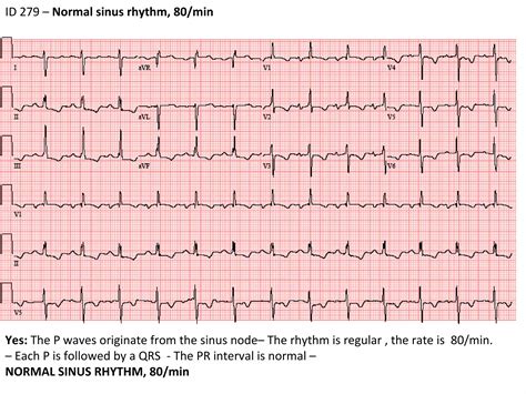 stepwise interpretation of ECG ID279 RVH | PPT