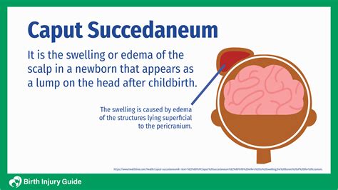 Cephalohematoma Vs Caput Succedaneum