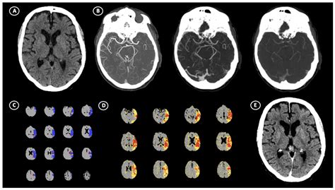 Ct-Perfusion Absolute Ghost Infarct Core Is a Rare Phenomenon ...
