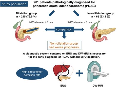 Enlarged Pancreatic Duct
