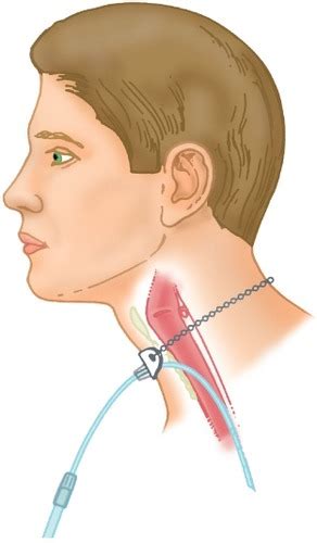 Image result for 8L O2 FiO2