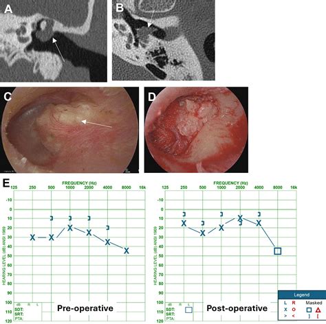 Management of Cholesteatoma - Otolaryngologic Clinics of North America