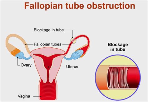 Image result for Fallopian Tube Blockage Surgery