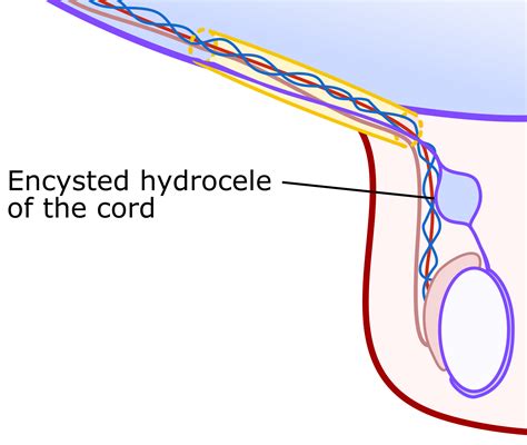 Hydrocele | Scrotal Lump | Geeky Medics - fluid in testicles