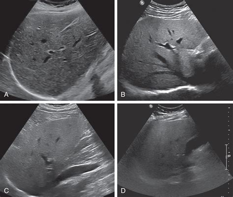 Usg Of Fatty Liver