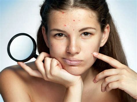 Pop These Myths Not Your Pimples | Femina.in