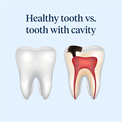 Healthcare Term For Cavities at Zane Morrison blog