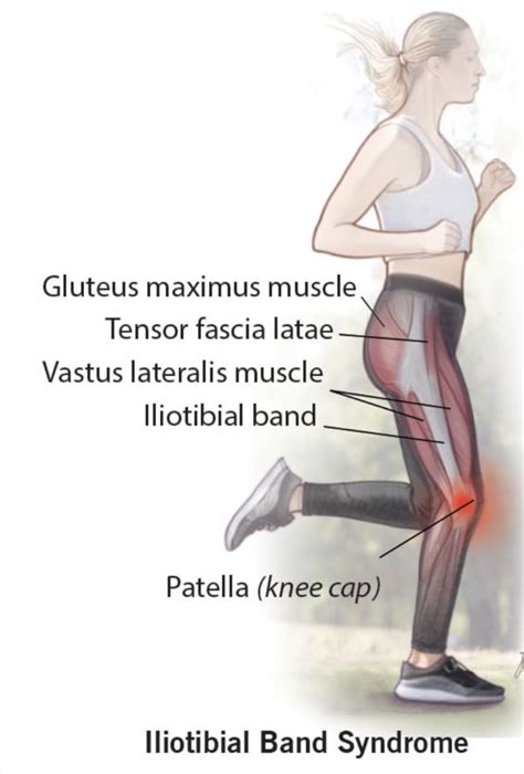 Iliotibial band syndrome (ITB) causes pain on the outside of the knee. It might affect one or ...
