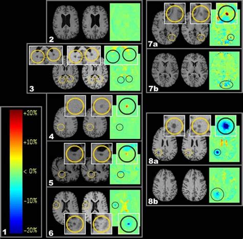 Individual Assessment of Brain Tissue Changes in MS and the Effect of ...