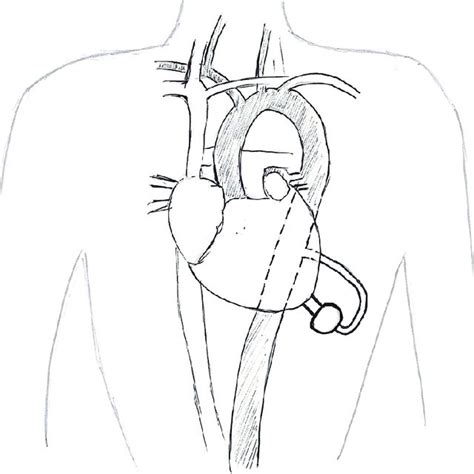 Image result for Left Thoracotomy