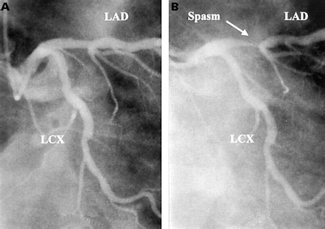 Angiographic documented coronary arterial spasm in absence of critical ...