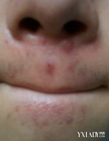 鼻子周围长痘痘是什么原因（可能是鼻子周围“不干净”）