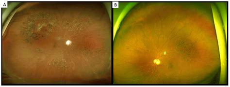 Polycythemia-Related Proliferative Ischemic Retinopathy Managed with ...