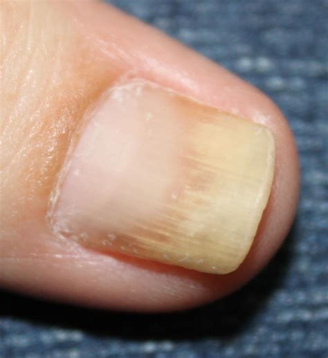 Nail Psoriasis Telltale Signs Of Nail Psoriasis And When Nail Psoriasis: Nail Psoriasis Symptoms ...