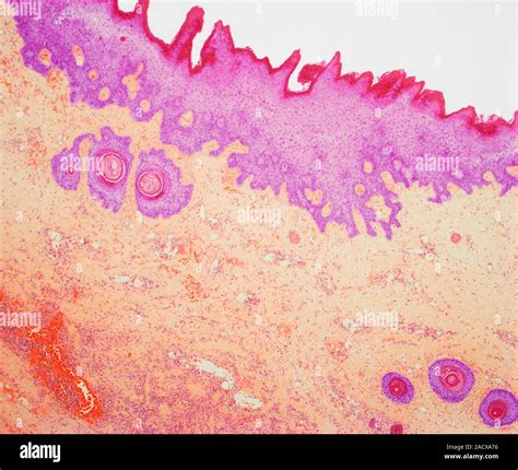 Necrotizing fasciitis, light micrograph of a section of infected skin ...