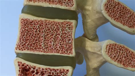 Osteoporosis: Causas, prevención y tratamiento