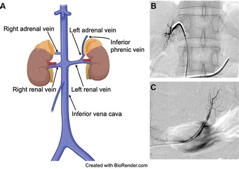 Intraprotocol Adrenal Vein Sampling Inconsistencies in Primary Aldosteronism LateralizationRadiology