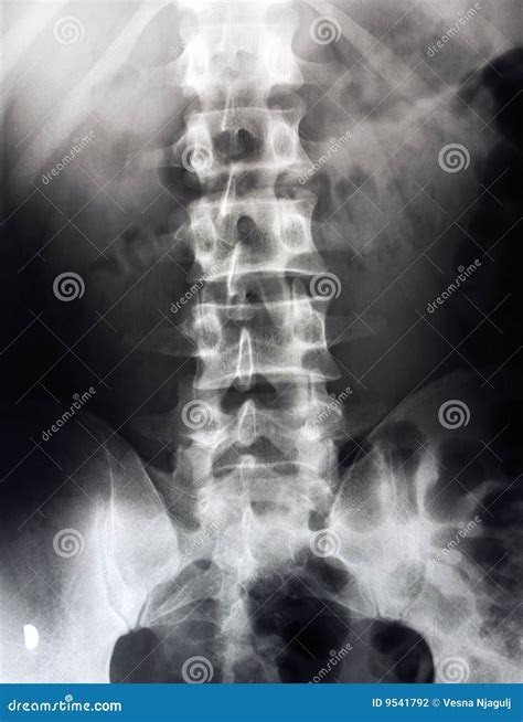 Lower Back X Ray