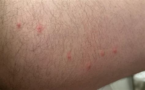 do these look like bed bug bites? : r/whatisthisbug