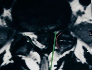 Spine Surgery | Orthonova Hospital - Jalandhar