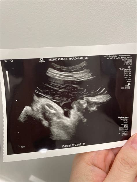 37 Week Ultrasound For Growth